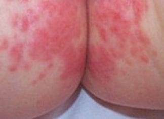 Como tratar assadura de bebê Como tratar assadura de bebê