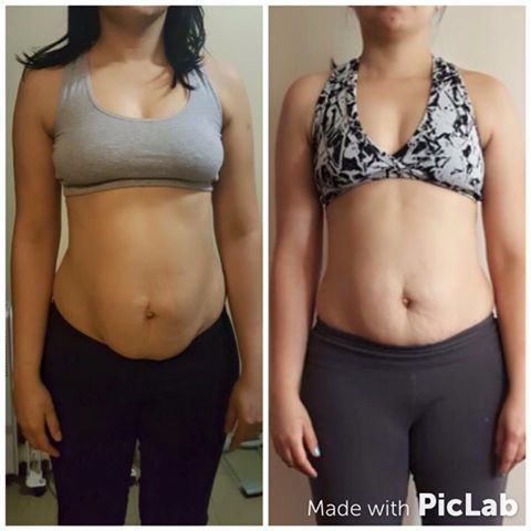 imagem barriga com diástase antes e depois com exercício - Edilene